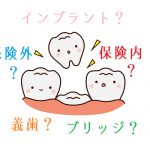私が抜歯後に保険外の一本義歯「ミラクルフィット」を入れようと思った理由