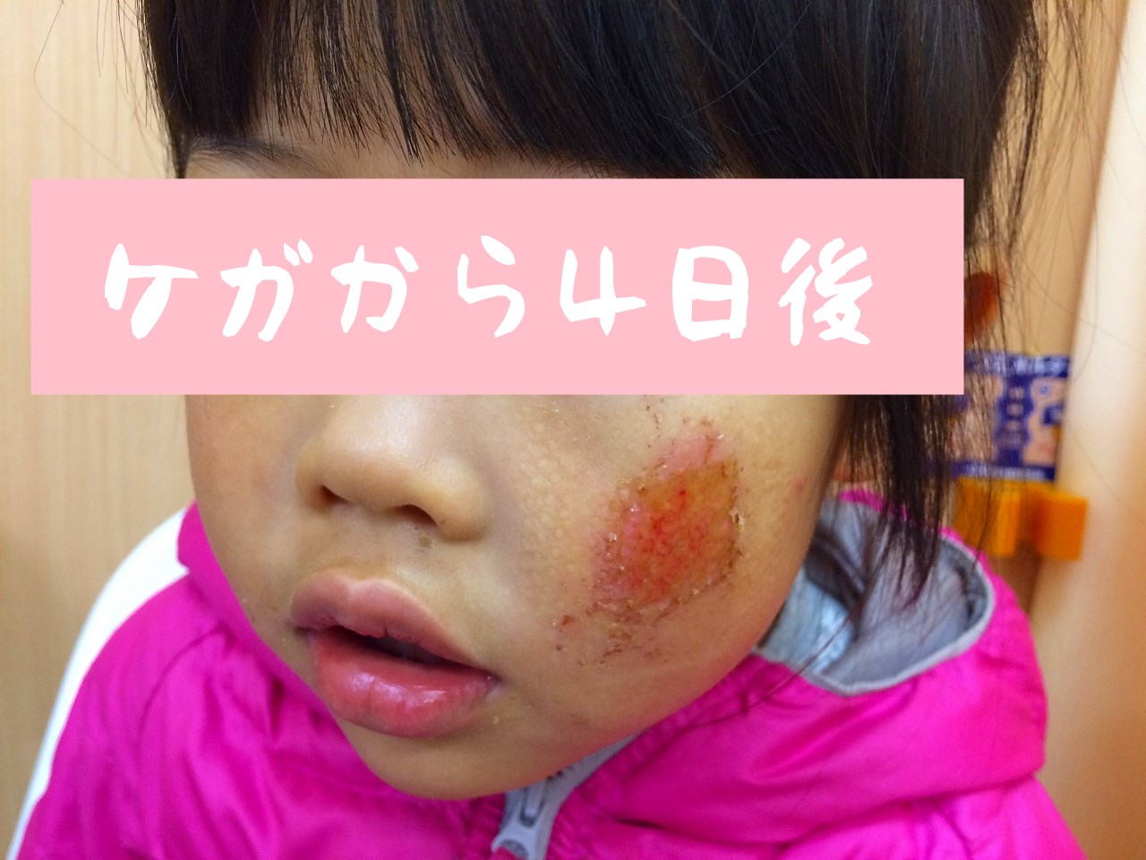 子どもの顔に大きな擦り傷が 病院の先生から聞いた跡が残りにくい治療法 はれうさぎの耳より情報ブログ